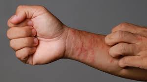 Gentle skin care treatment &mdash; eczema, psoriasis